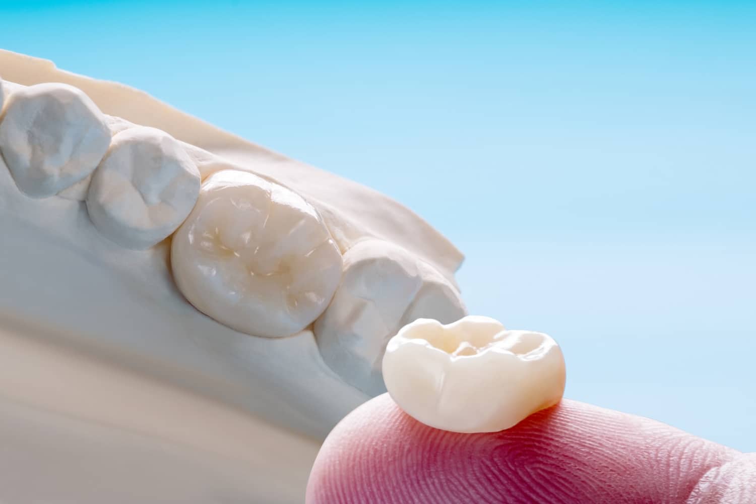 When Is a Crown the Best Option for a Damaged Tooth?