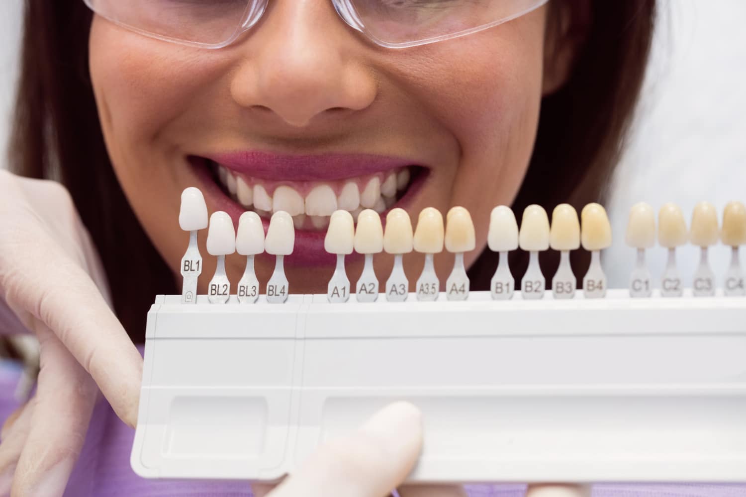 What Are the Different Types of Veneers?