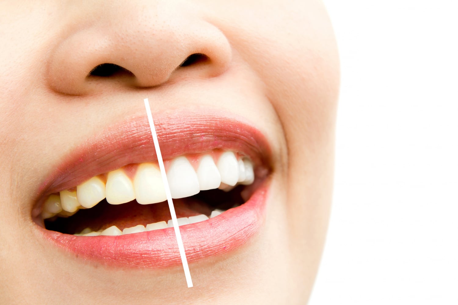 Why Is My Tooth Discolored?