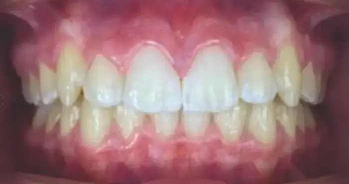 After Angel Aligner treatment showing improved tooth alignment and bite