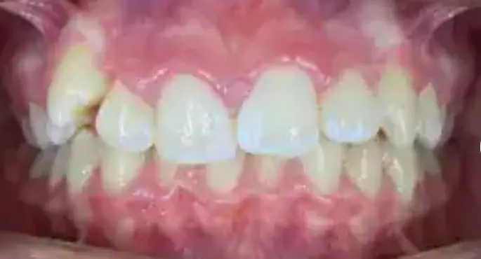 Before Angel Aligner treatment showing tooth alignment and bite